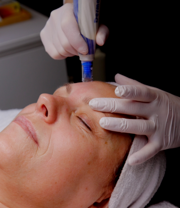 microneedling